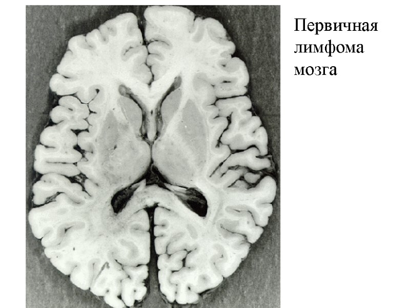Первичная лимфома мозга